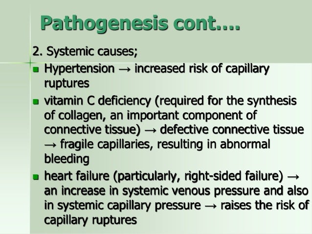 Epistaxis Epistaxis