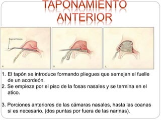 1. El tapón se introduce formando pliegues que semejan el fuelle
de un acordeón.
2. Se empieza por el piso de la fosas nasales y se termina en el
atico.
3. Porciones anteriores de las cámaras nasales, hasta las coanas
si es necesario. (dos puntas por fuera de las narinas).
 