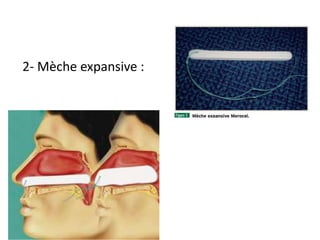 2- Mèche expansive :
 