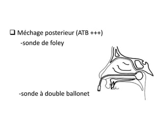  Méchage posterieur (ATB +++)
-sonde de foley
-sonde à double ballonet
 