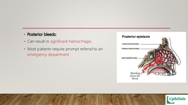 Epistaxis update management 