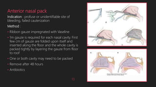 Anterior nasal pack
Indication : profuse or unidentifiable site of
bleeding, failed cauterization
Method :
• Ribbon gauze impregnated with Vaseline
• 1m gauze is required for each nasal cavity. First
few cm of gauze are folded upon itself and
inserted along the floor and the whole cavity is
packed tightly by layering the gauze from floor
to roof
• One or both cavity may need to be packed
• Remove after 48 hours
• Antibiotics
13
 