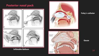 14
Posterior nasal pack
Inflatable Balloon
Foley’s catheter
Gauze
 