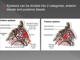  Epistaxis can be divided into 2 categories, anterior
bleeds and posterior bleeds
 