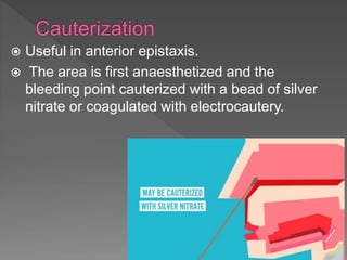  Useful in anterior epistaxis.
 The area is first anaesthetized and the
bleeding point cauterized with a bead of silver
nitrate or coagulated with electrocautery.
 