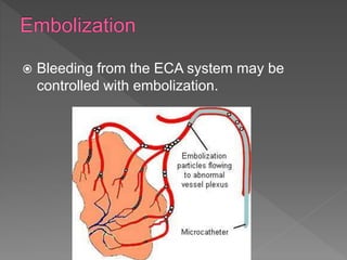  Bleeding from the ECA system may be
controlled with embolization.
 