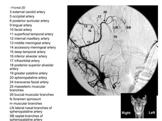 - Frontal 2D
3 external carotid artery
5 occipital artery
6 posterior auricular artery
9 lingual artery
10 facial artery
11 superficial temporal artery
12 internal maxillary artery
13 middle meningeal artery
14 accessory meningeal artery
15 deep temporal artery
16 inferior alveolar artery
17 infraorbital artery
18 posterior superior alveolar
artery
19 greater palatine artery
20 sphenopalatine artery
24 transverse facial artery
25 masseteric muscular
branches
26 buccal muscular branches
fs foramen spinosum
m muscular branches
LN lateral nasal branches of
sphenopalatine artery
SB septal branches of
sphenopalatine artery
 