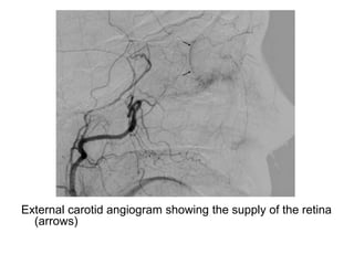 External carotid angiogram showing the supply of the retina
(arrows)
 