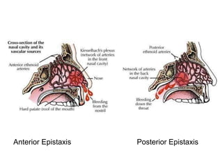 Anterior Epistaxis Posterior Epistaxis
 