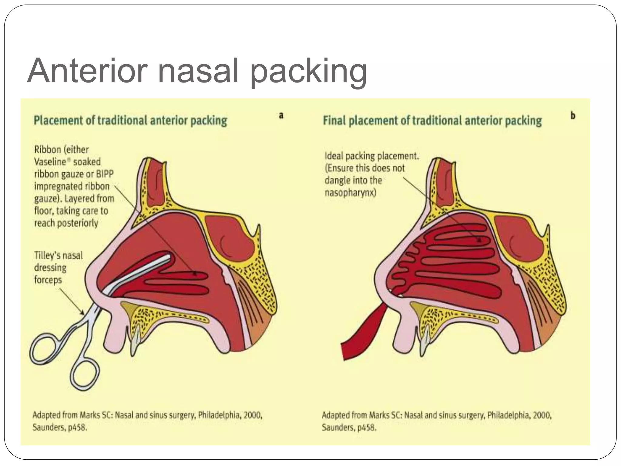 EPISTAXIS.pptx