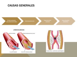 CAUSAS GENERALES
Enfermedades
vasculotensionales
Arterioesclerosis
Hipertensión
arterial
Vasculopatía
diabética
 