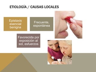 ETIOLOGÍA / CAUSAS LOCALES
Epistaxis
esencial
benigna
Frecuente,
espontánea
Favorecida por
exposición al
sol, esfuerzos
 