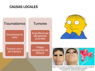 CAUSAS LOCALES
Traumatismos
Escarbarse la
nariz
Trauma con o
sin fractura
Tumores
Angiofibromas
sangrantes
juveniles
Pólipo
sangrante del
tabique
 