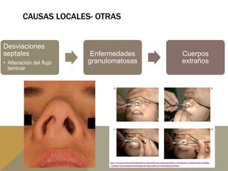 CAUSAS LOCALES- OTRAS
Desviaciones
septales
• Alteración del flujo
laminar
Enfermedades
granulomatosas
Cuerpos
extraños
 