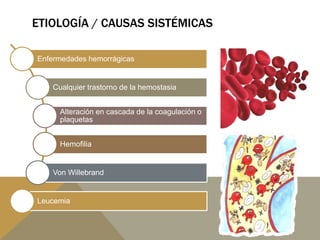 ETIOLOGÍA / CAUSAS SISTÉMICAS
Enfermedades hemorrágicas
Cualquier trastorno de la hemostasia
Alteración en cascada de la coagulación o
plaquetas
Hemofilia
Von Willebrand
Leucemia
 
