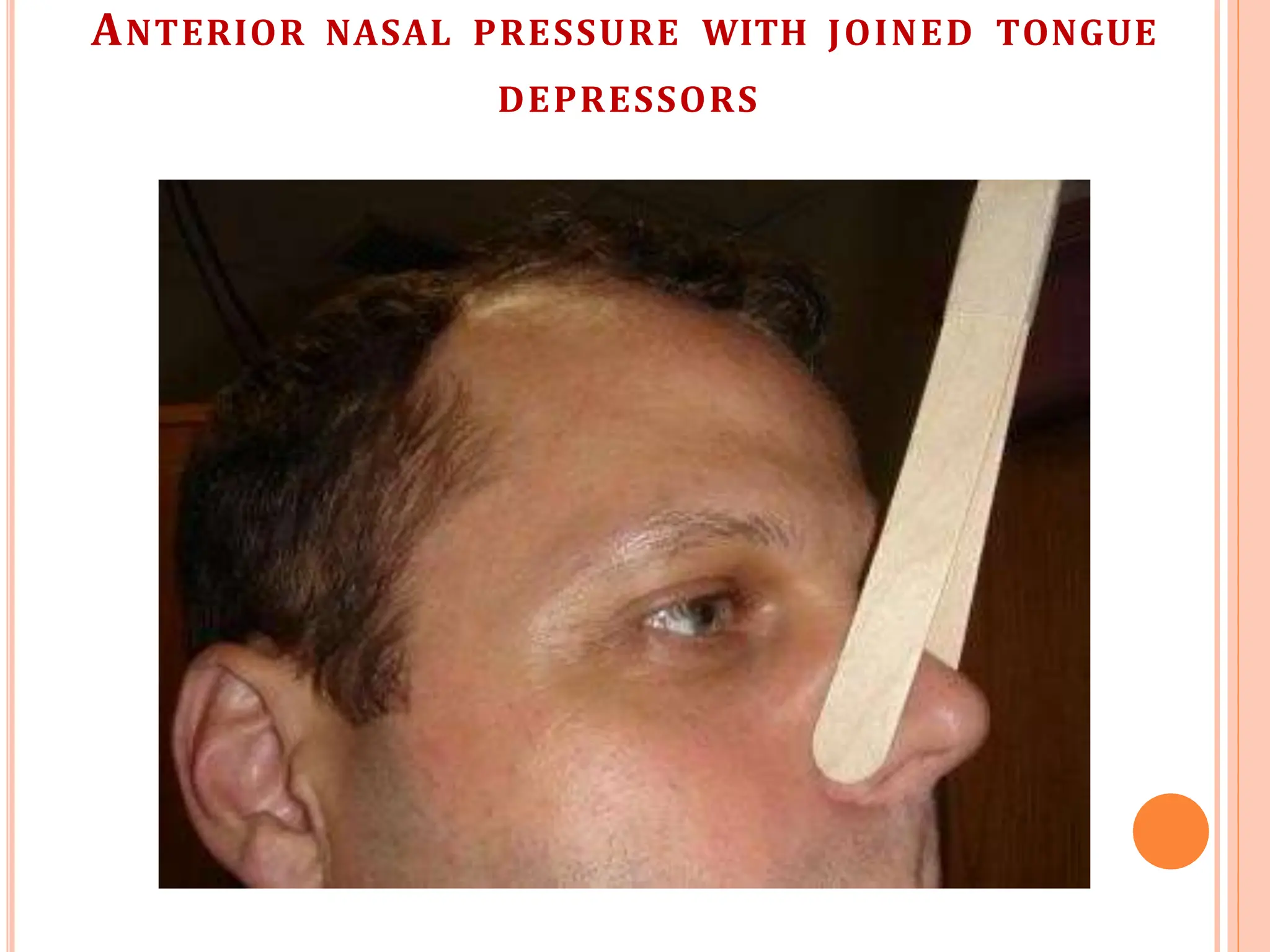 ANTERIOR NASAL PRESSURE WITH JOINED TONGUE
DEPRESSORS
 