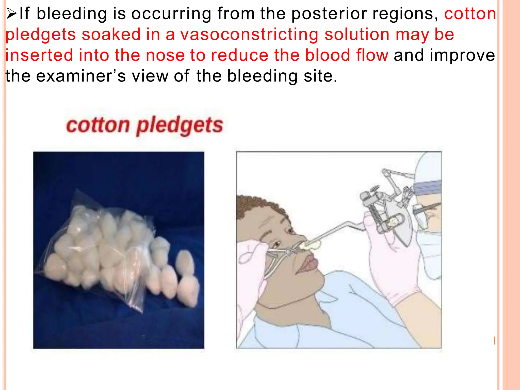 If bleeding is occurring from the posterior regions, cotton
pledgets soaked in a vasoconstricting solution may be
inserted into the nose to reduce the blood flow and improve
the examiner’s view of the bleeding site.
 