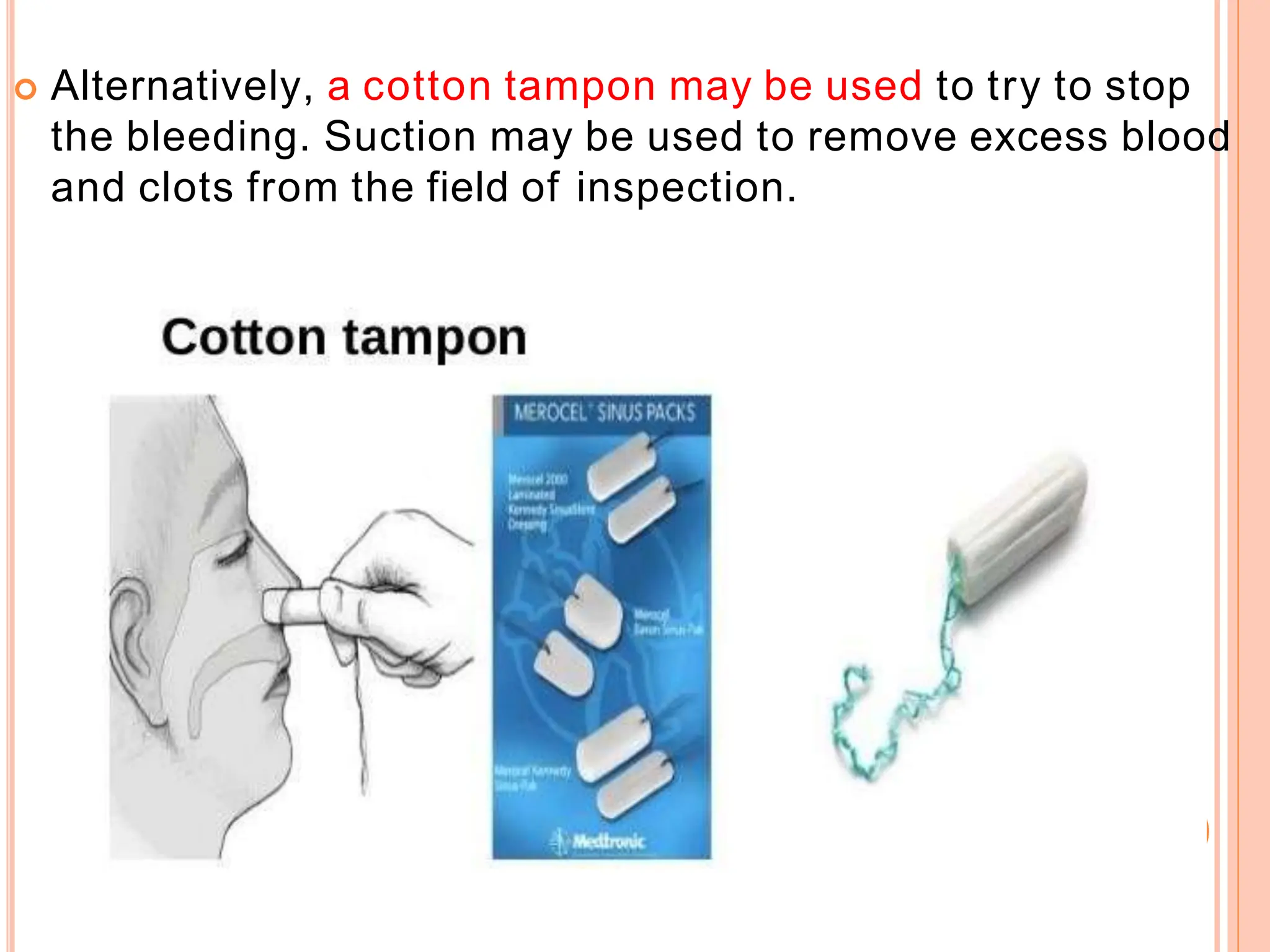  Alternatively, a cotton tampon may be used to try to stop
the bleeding. Suction may be used to remove excess blood
and clots from the field of inspection.
 