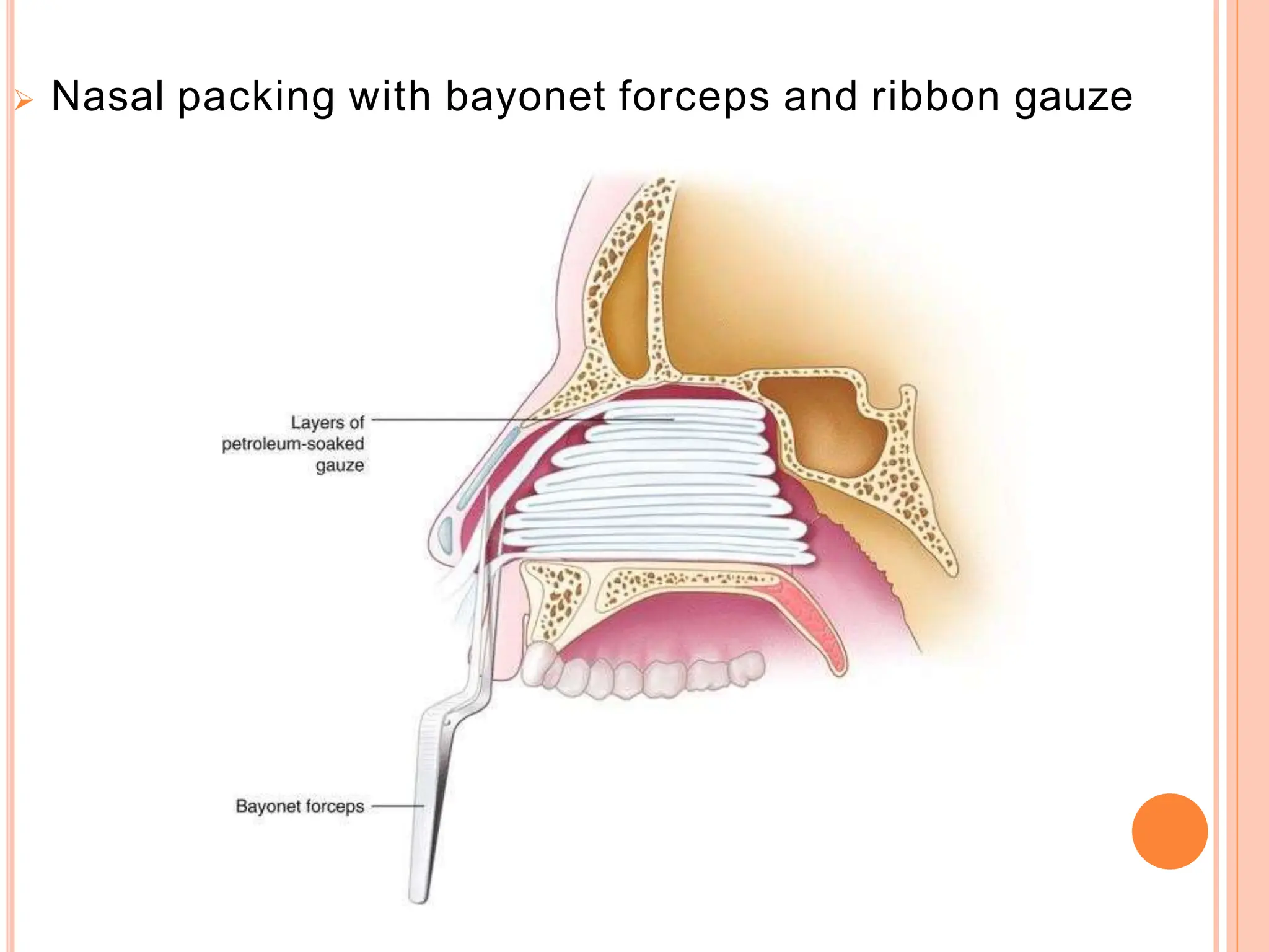  Nasal packing with bayonet forceps and ribbon gauze
 