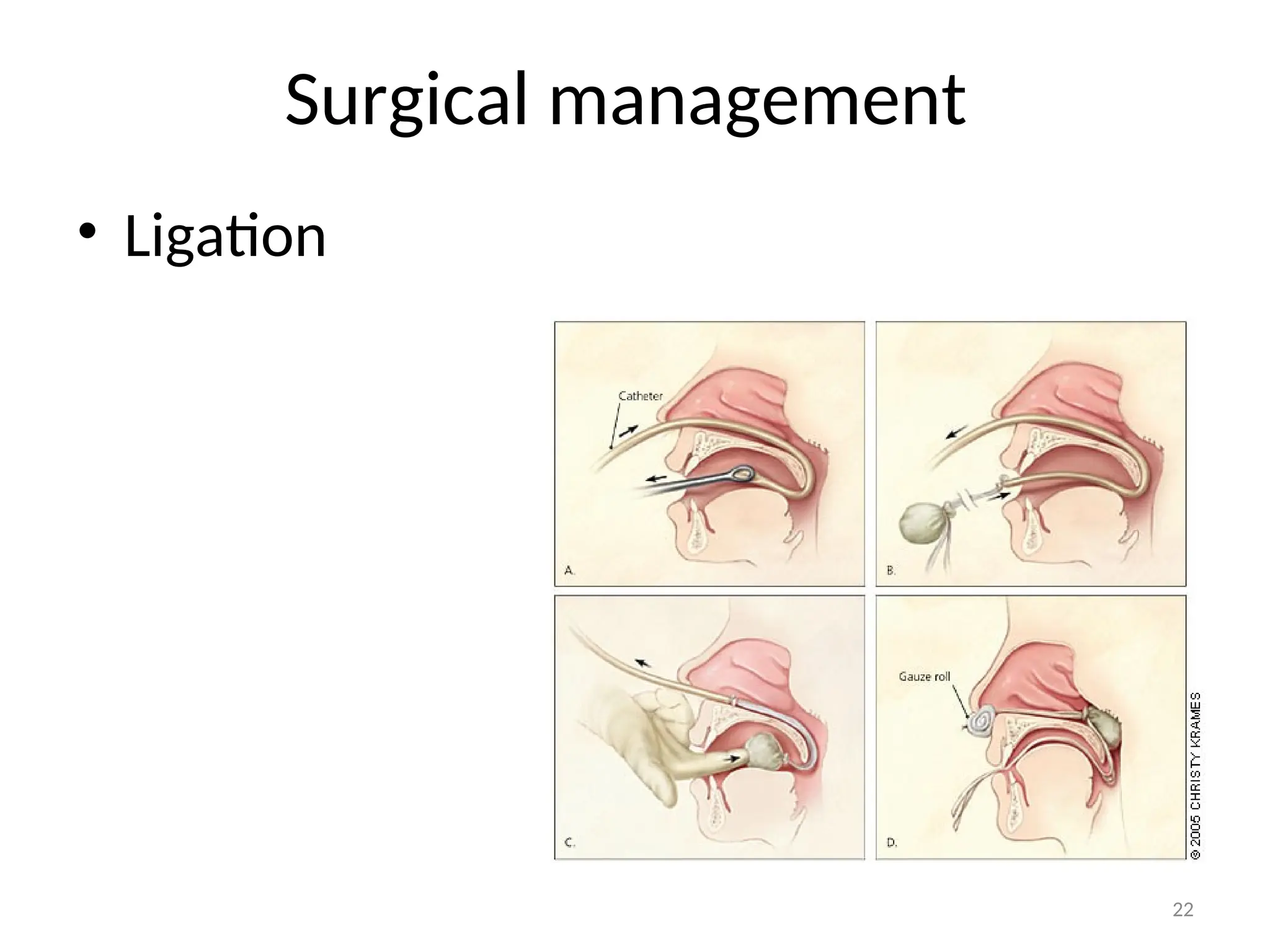 Surgical management
• Ligation
22
 