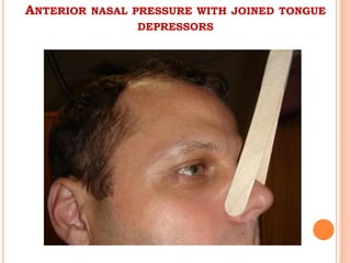 ANTERIOR NASAL PRESSURE WITH JOINED TONGUE
DEPRESSORS
 