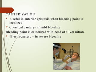 Epistaxis- etiology, symptoms, management .pptx