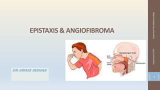 EPISTAXIS & ANGIOFIBROMA
DR AWAIS IRSHAD
Fazaia
Ruth
Pfau
Medical
College
Department
of
ENT
1
 