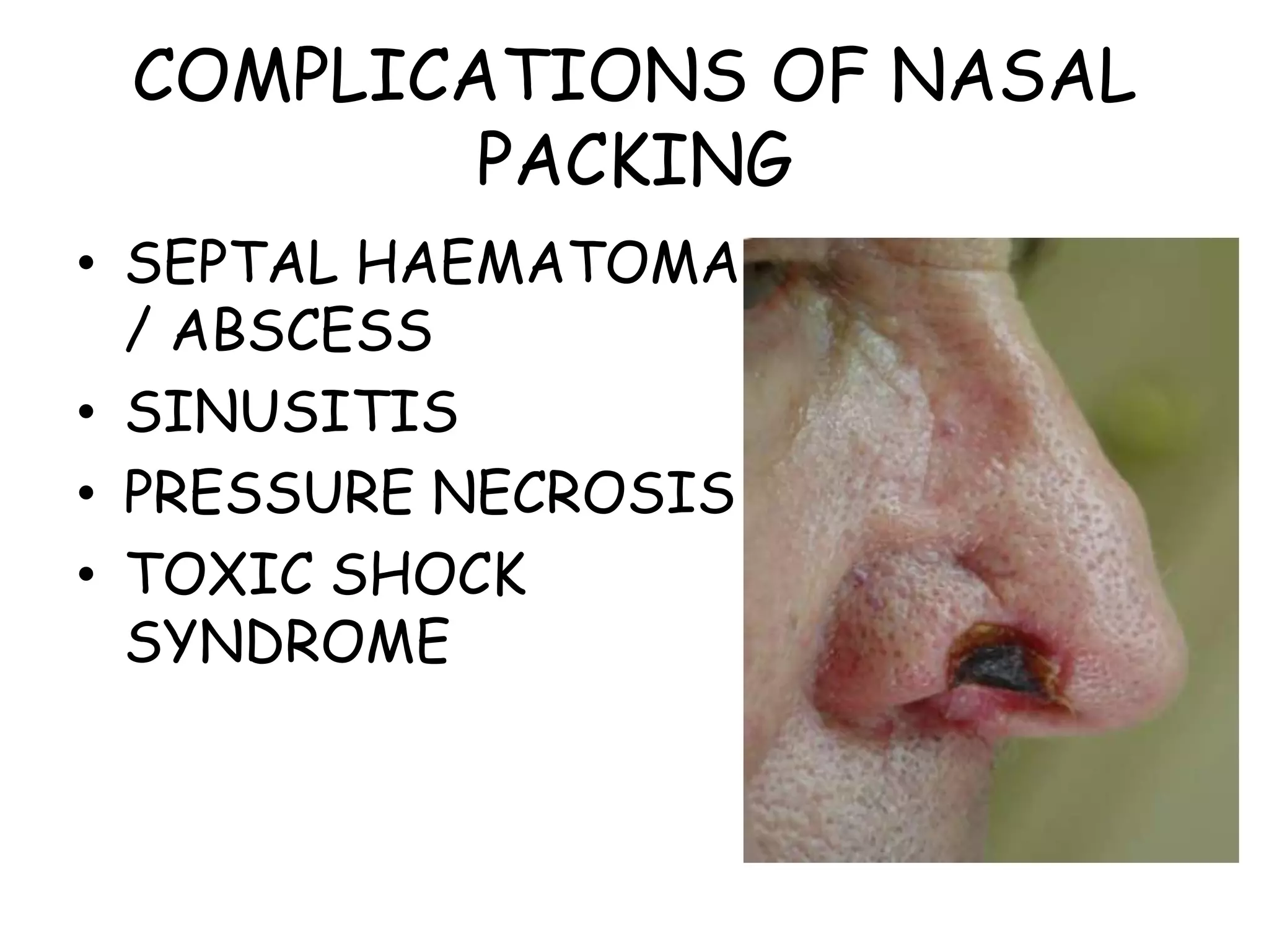 COMPLICATIONS OF NASAL
PACKING
• SEPTAL HAEMATOMA
/ ABSCESS
• SINUSITIS
• PRESSURE NECROSIS
• TOXIC SHOCK
SYNDROME
 