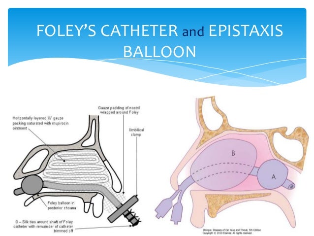 Epistaxis Epistaxis