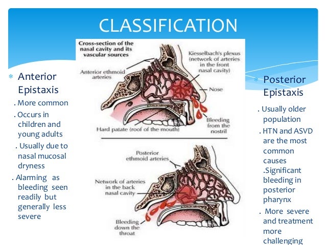 Epistaxis Epistaxis