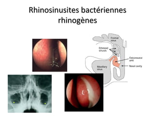 Rhinosinusites bactériennesRhinosinusites bactériennes
rhinogènesrhinogènes
 