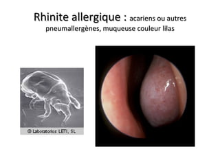 Rhinite allergique :Rhinite allergique : acariens ou autresacariens ou autres
pneumallergènes, muqueuse couleur lilaspneumallergènes, muqueuse couleur lilas
 