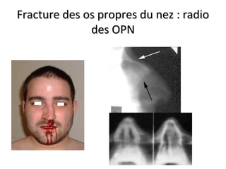 Fracture des os propres du nez : radioFracture des os propres du nez : radio
des OPNdes OPN
 
