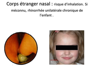 Corps étranger nasal :Corps étranger nasal : risque d’inhalation.risque d’inhalation. SiSi
méconnu,méconnu, rhinorrhée unilatérale chronique derhinorrhée unilatérale chronique de
l’enfant .l’enfant .
 