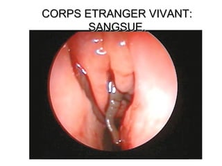 CORPS ETRANGER VIVANT:CORPS ETRANGER VIVANT:
SANGSUE.SANGSUE.
 
