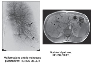 Malformations artério veineusesMalformations artério veineuses
pulmonaires: RENDU OSLERpulmonaires: RENDU OSLER
Nodules hépatiques:Nodules hépatiques:
RENDU OSLERRENDU OSLER
 