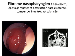 Fibrome nasopharyngien :Fibrome nasopharyngien : adolescent,adolescent,
épistaxis répétés et obstruction nasale récente,épistaxis répétés et obstruction nasale récente,
tumeur bénigne très vasculariséetumeur bénigne très vascularisée.
 