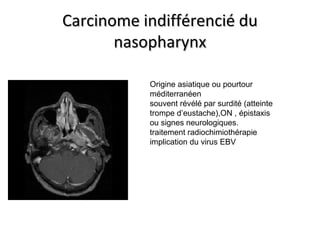 Carcinome indifférencié duCarcinome indifférencié du
nasopharynxnasopharynx
Origine asiatique ou pourtour
méditerranéen
souvent révélé par surdité (atteinte
trompe d’eustache),ON , épistaxis
ou signes neurologiques.
traitement radiochimiothérapie
implication du virus EBV
 