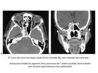 CT scans des sinus en coupe axiale (A) et coronale (B), avec injection de contraste :
Anévrysme trilobé du segment intra caverneux de l’ artère carotide interne droite
avec érosion paroi externe sinus sphénoidal.
 