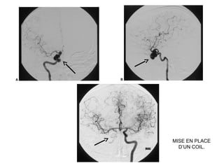 MISE EN PLACE
D’UN COIL.
 