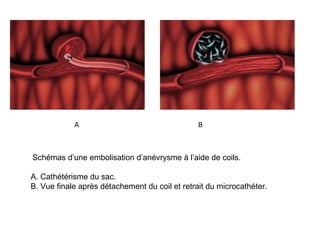 Schémas d’une embolisation d’anévrysme à l’aide de coils.
A. Cathétérisme du sac.
B. Vue finale après détachement du coil et retrait du microcathéter.
A B
 