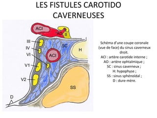 LES FISTULES CAROTIDO
CAVERNEUSES
Schéma d’une coupe coronale
(vue de face) du sinus caverneux
droit.
ACI : artère carotide interne ;
AO : artère ophtalmique ;
SC : sinus caverneux ;
H: hypophyse ;
SS : sinus sphénoïdal ;
D : dure-mère.
 