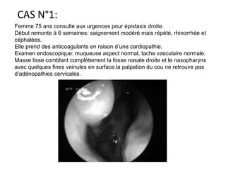CAS N°1:
Femme 75 ans consulte aux urgences pour épistaxis droite.
Début remonte à 6 semaines: saignement modéré mais répété, rhinorrhée et
céphalées.
Elle prend des anticoagulants en raison d’une cardiopathie.
Examen endoscopique: muqueuse aspect normal, tache vasculaire normale.
Masse lisse comblant complètement la fosse nasale droite et le nasopharynx
avec quelques fines veinules en surface.la palpation du cou ne retrouve pas
d’adénopathies cervicales.
 