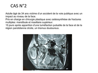 CAS N°2
Adulte âgé de 34 ans victime d’un accident de la voie publique avec un
impact au niveau de la face.
Pris en charge en chirurgie plastique avec ostéosynthèse de fractures
multiples: mandibule et maxillaire supérieur.
15 jours après apparition d’une tuméfaction pulsatile de la face et de la
région parotidienne droite, un trismus douloureux.
 