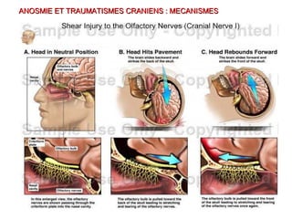 ANOSMIE ET TRAUMATISMES CRANIENS : MECANISMESANOSMIE ET TRAUMATISMES CRANIENS : MECANISMES
 
