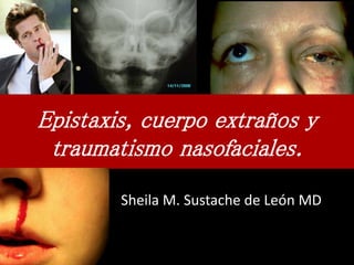 Epistaxis, cuerpo extraños y
traumatismo nasofaciales.
Sheila M. Sustache de León MD
 