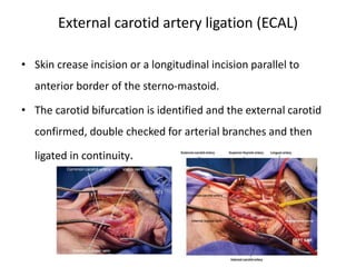 Epistaxis By Dr. Pradipta Kumar Parida ,AIIMS Bhubaneswar | PPT