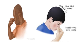 Epistaxis or Nose bleeding | PPT