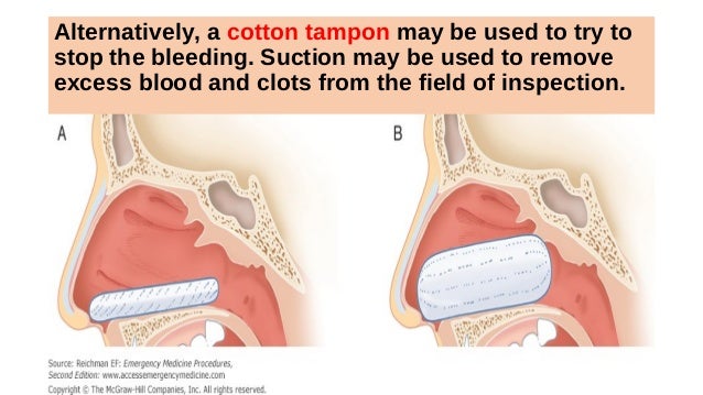 Epistaxis Or Nose Bleeding Epistaxis Or Nose Bleeding