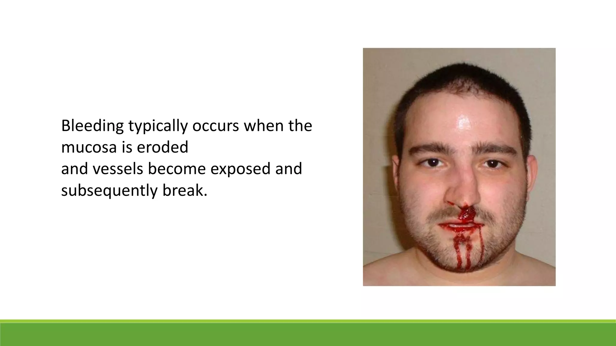 Bleeding typically occurs when the
mucosa is eroded
and vessels become exposed and
subsequently break.
 